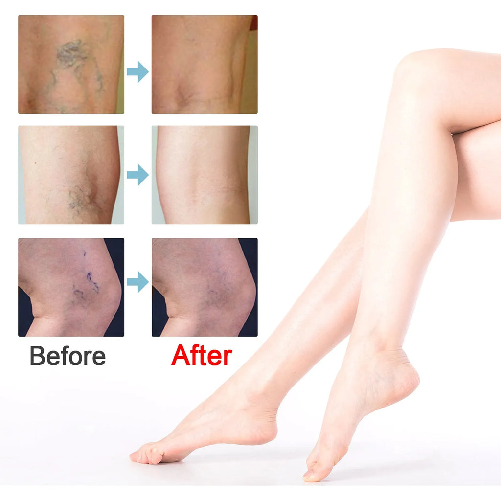20g tube of vein repair cream for earthworm leg and green tendon bulge relief.