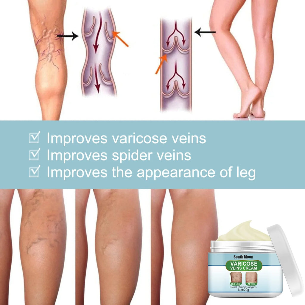 20g tube of vein repair cream for earthworm leg and green tendon bulge relief.