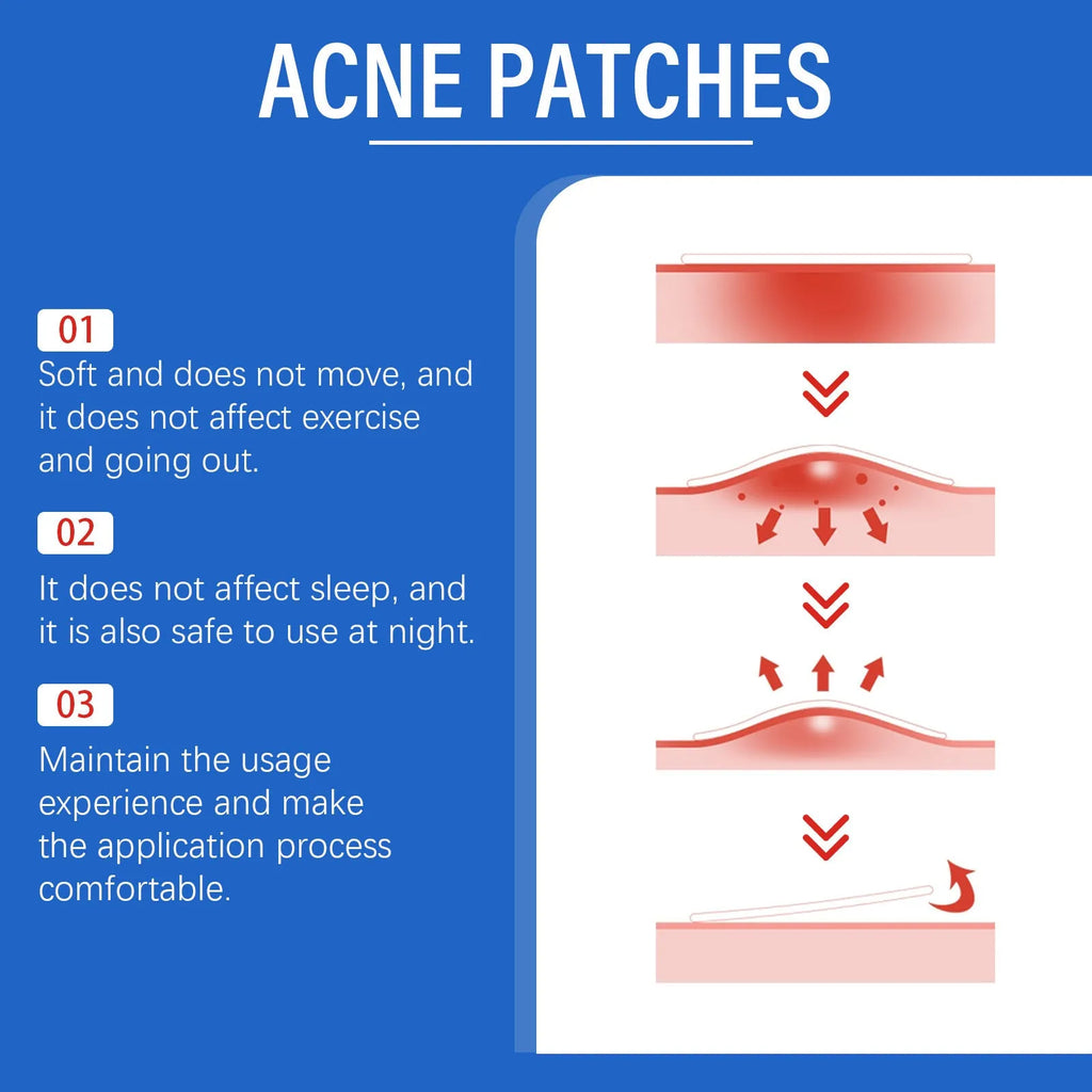 Pack of 216 acne patches with tea tree oil and Vitamin E for facial blemish treatment