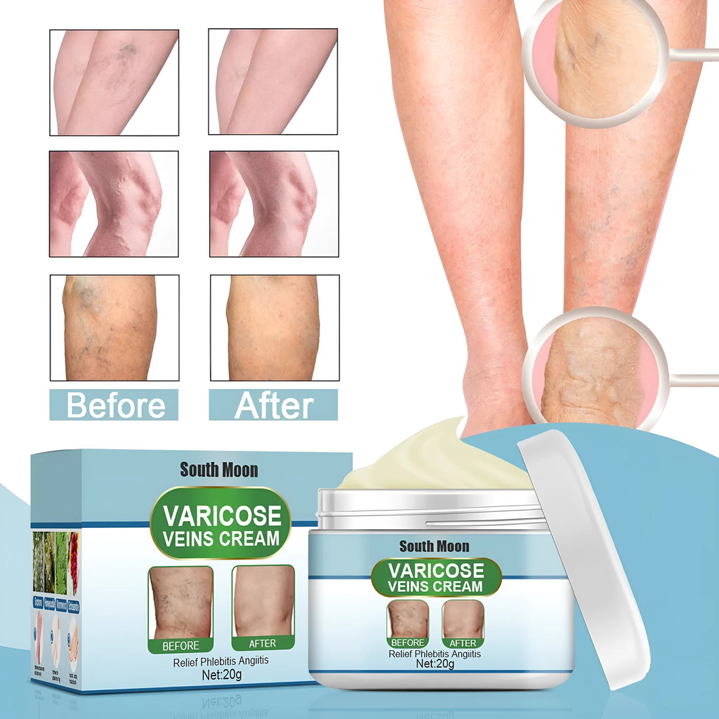 20g tube of vein repair cream for earthworm leg and green tendon bulge relief.
